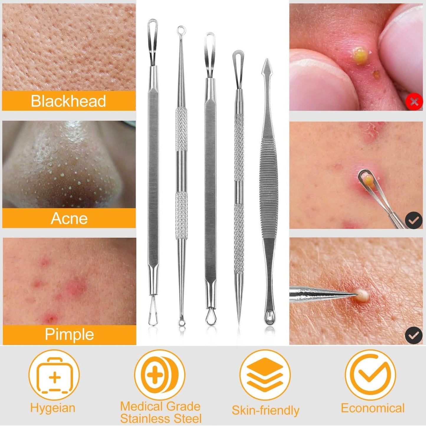5-Piece Set: Blackhead Remover Kit Stainless Steel